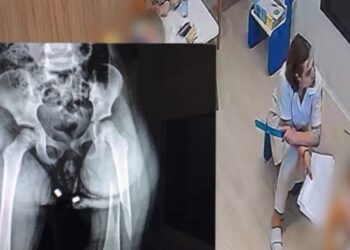 Pamjet e reja nga momenti kur fëmijes i thyejnë këmbën