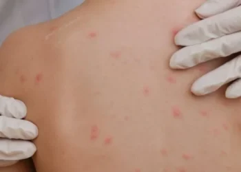 OBSH: Rritje e frikshme e rasteve të fruthit në Evropë