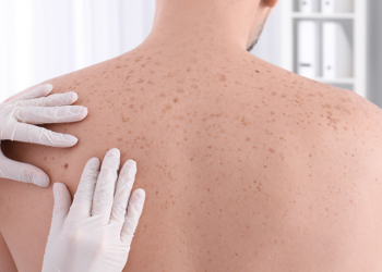 Aplikacioni i ri me AI ndihmon në zbulimin e kancerit të lëkurës në fazat e hershme