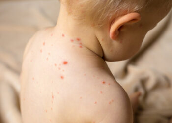 Fruthi rikthehet në Shqipëri, 12 fëmijë të prekur në 3 muaj