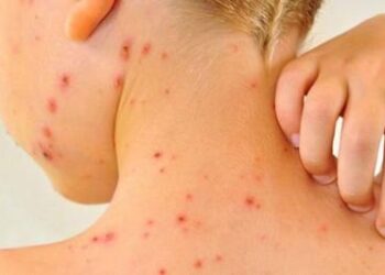 Rritja e rasteve me fruth, ekspertja apel për vaksinimin e fëmijëve