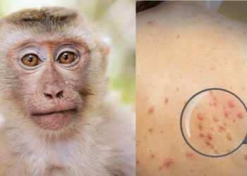 Shfaqet rasti i parë me linë e majmunit në Shqipëri, konfirmohet tek një 30-vjeçar që kishte udhëtuar jashtë vendit