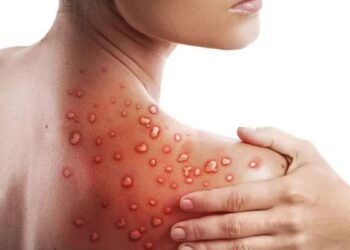 “S’ka vend për panik për linë e majmunit”/ Mjeku: Ja shenjat dalluese të kësaj sëmundjeje