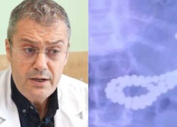 Vogëlushja 3-vjeçare gëlltit 62 rruaza magnetike, flet mjeku i Pediatrisë