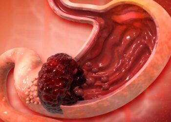 Alarm për kancerin e stomakut në Shqipëri! Mjekët: 13 të prekur në 100 mijë banorë