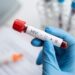 Rritet numri i të infektuarve me HIV në Kosovë: 10 raste të reja vetëm në pesë muaj