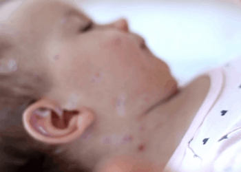 Vaksinimi i fëmijëve, OBSH: Ende larg nivelit për të parandaluar fruthin