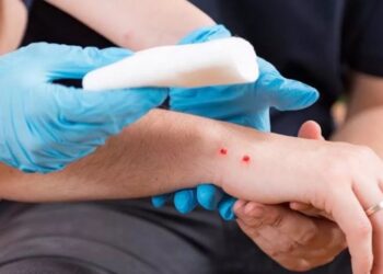 Vapa shton pickimet nga gjarpëri, toksikologia: Kujdes me trajtimin, mos e lidhni ose shponi plagën