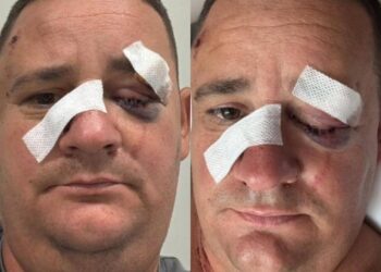 U dhunua nga pronarët e lokalit “Stockholm”, dalin pamjet nga spitali të biznesmenit Laert Kasaj